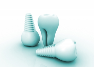 Illustration for article titled The Best Area to Acquire Dental Implants Is South of the Country's Border